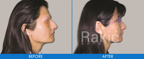 Nose surgery (Rhynoplasty)